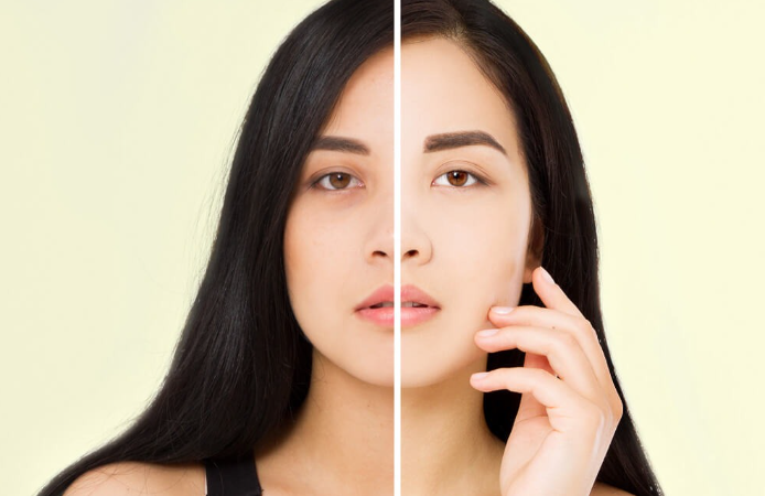 Get Rid of Dark Circles